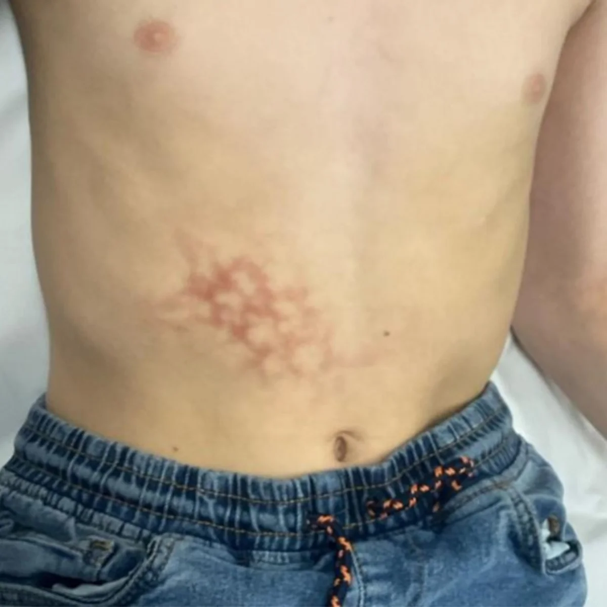 Menino desenvolve dermatose rara por usar notebook encostado na barriga