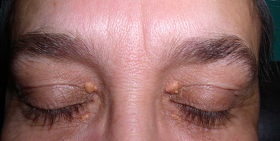 Manchas e protuber&acirc;ncias amareladas nos olhos s&atilde;o chamadas de xantelasma Foto: Wikimedia
