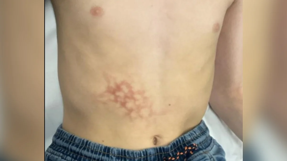Menino desenvolve dermatose rara por usar notebook encostado na barriga
