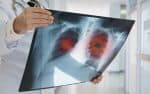 Adenocarcinoma de pulmão: o que é a doença detectada no Papa Leão XIV