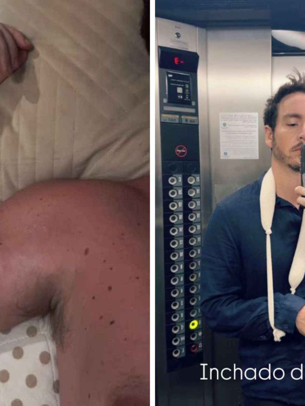 Ator da Globo Wagner Santisteban mostra hematomas após acidente na academia: 'Doendo muito'
