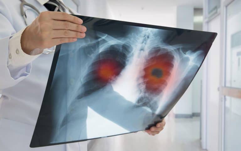 Adenocarcinoma de pulmão: o que é a doença detectada no Papa Leão XIV