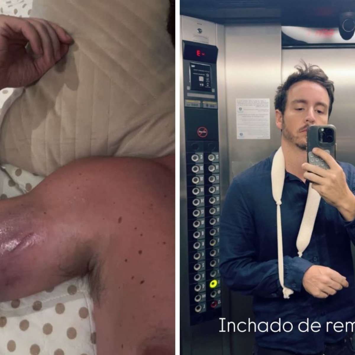 Ator da Globo Wagner Santisteban mostra hematomas após acidente na academia: 'Doendo muito'