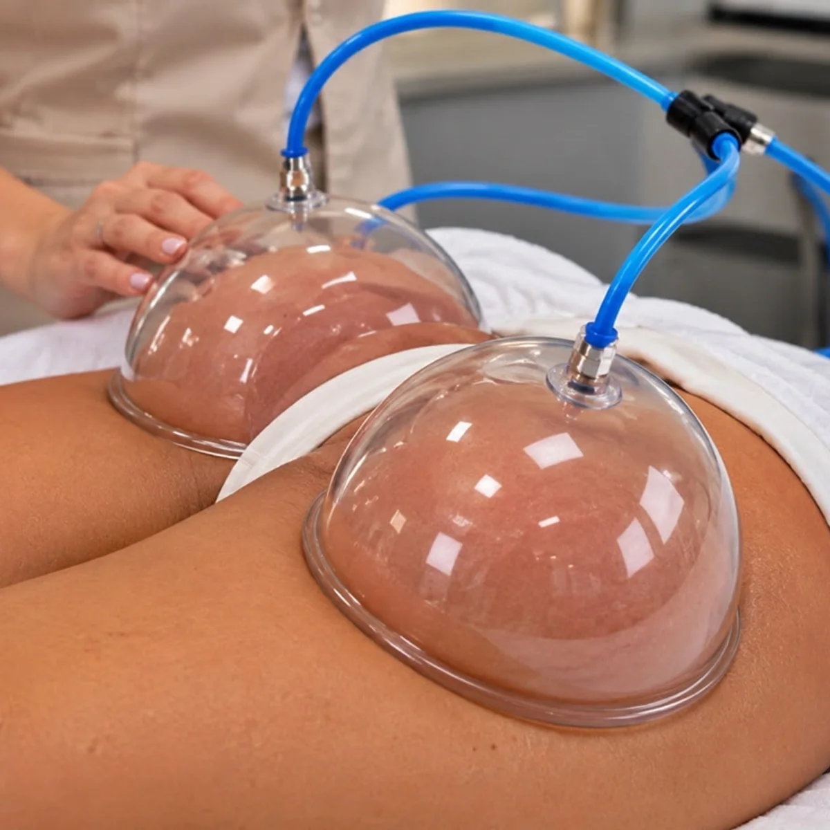 Ventosa no bumbum: médico desvenda técnica que promete aumentar volume