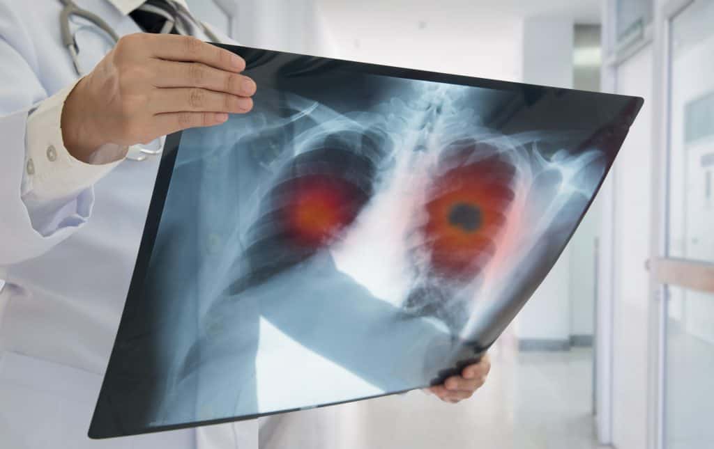 Adenocarcinoma de pulmão: o que é a doença detectada no Papa Leão XIV